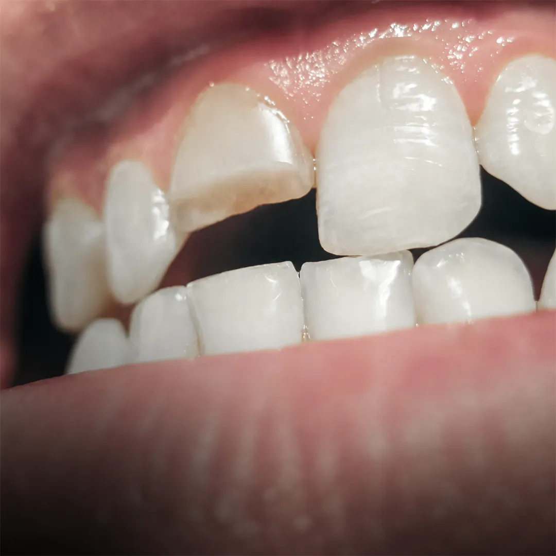 Restauração Dental em Niterói